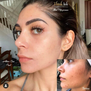 Think Ink Micro-Esthetics, Acne treatment, acne, clear skin, acne scarring, Accutane, pimple, blackheads, differin gel, benzoyl peroxide, zit, isotret, tretinoin cream 0.025, pimple patch, Clear Skin Acne System