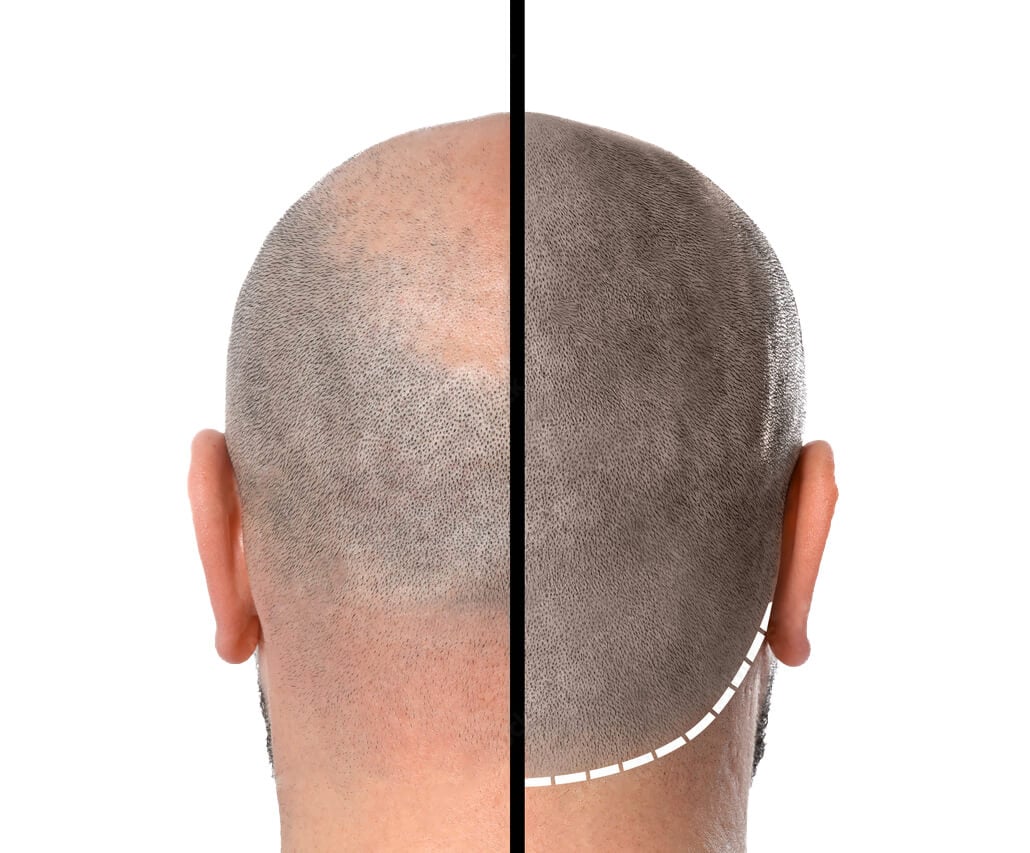 Think Ink Micro-Esthetics, SMP Miami, Alopecia, Scalp Micropigmentation, Hair Loss, Hair Transplant, hair thinning, baldness, SMP