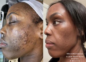 Think Ink Micro-Esthetics, Acne treatment, acne, clear skin, acne scarring, Accutane, pimple, blackheads, differin gel, benzoyl peroxide, zit, isotret, tretinoin cream 0.025, pimple patch, Clear Skin Acne System