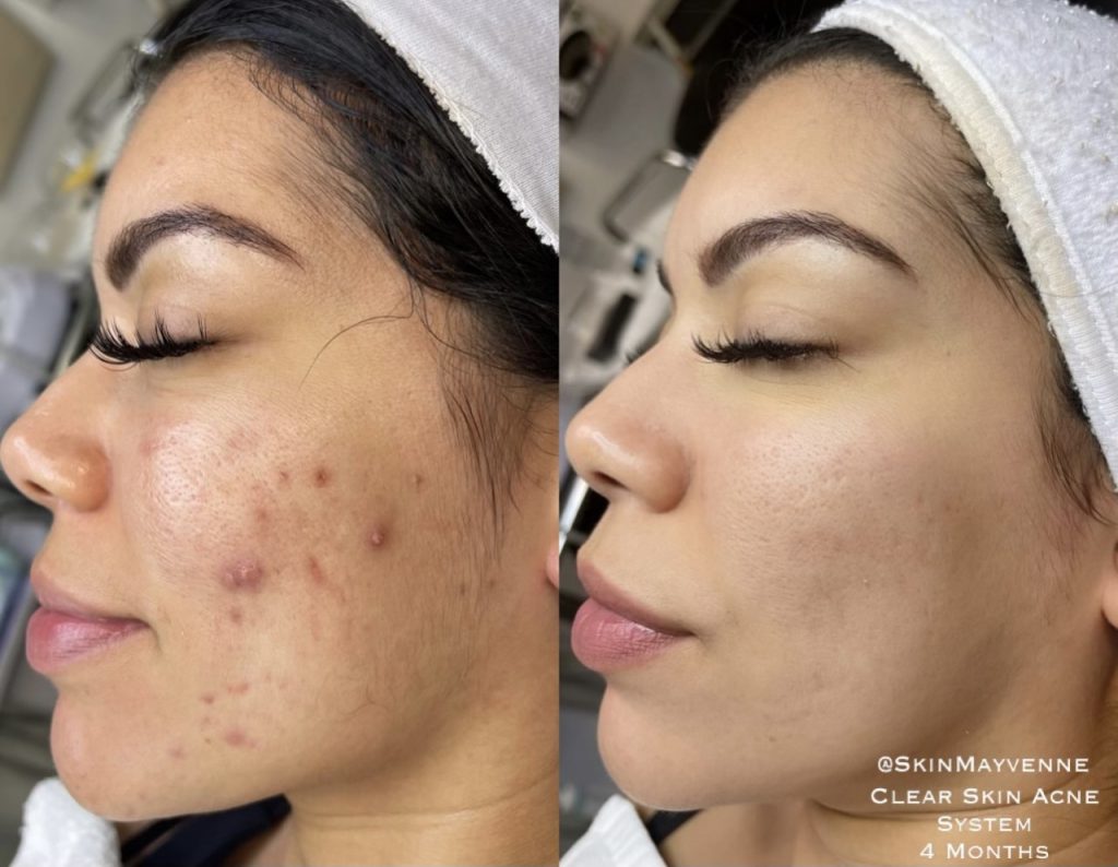Think Ink Micro-Esthetics, Acne treatment, acne, clear skin, acne scarring, Accutane, pimple, blackheads, differin gel, benzoyl peroxide, zit, isotret, tretinoin cream 0.025, pimple patch