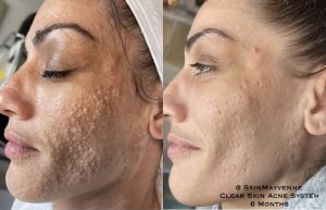 Think Ink Micro-Esthetics, Acne treatment, acne, clear skin, acne scarring, Accutane, pimple, blackheads, differin gel, benzoyl peroxide, zit, isotret, tretinoin cream 0.025, pimple patch, Clear Skin Acne System
