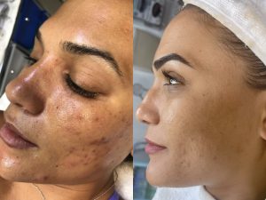 Think Ink Micro-Esthetics, Acne treatment, acne, clear skin, acne scarring, Accutane, pimple, blackheads, differin gel, benzoyl peroxide, zit, isotret, tretinoin cream 0.025, pimple patch, Clear Skin Acne System