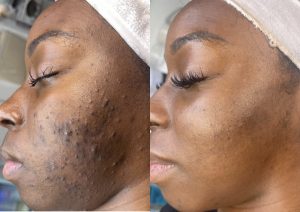 Think Ink Micro-Esthetics, Acne treatment, acne, clear skin, acne scarring, Accutane, pimple, blackheads, differin gel, benzoyl peroxide, zit, isotret, tretinoin cream 0.025, pimple patch, Clear Skin Acne System