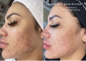 Think Ink Micro-Esthetics, Acne treatment, acne, clear skin, acne scarring, Accutane, pimple, blackheads, differin gel, benzoyl peroxide, zit, isotret, tretinoin cream 0.025, pimple patch, Clear Skin Acne System