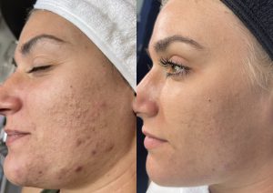 Think Ink Micro-Esthetics, Acne treatment, acne, clear skin, acne scarring, Accutane, pimple, blackheads, differin gel, benzoyl peroxide, zit, isotret, tretinoin cream 0.025, pimple patch, Clear Skin Acne System