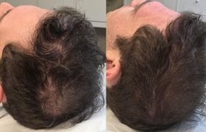 Think Ink Micro-Esthetics SMP Miami Alopecia Scalp Micropigmentation Norwood 7 Hair Loss Hair Transplant hair thinning baldness