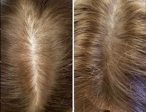 Think Ink Micro-Esthetics, SMP, Miami, Alopecia, Scalp Micropigmentation, woman's Hair Loss, hair thinning