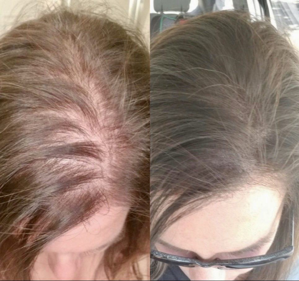 Think Ink Micro-Esthetics, SMP, Miami, Alopecia, Scalp Micropigmentation, woman's Hair Loss, hair thinning