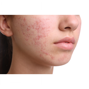 Think Ink Micro-Esthetics, acne treatment, acne