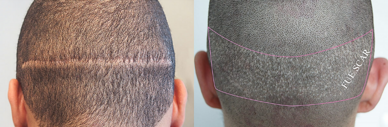 hair transplant scars, think ink micro esthetics, smp, scalp micropigmentation, Scalp micropigmentation for camouflaging hair transplant scars 4