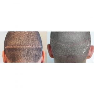hair transplant scars, think ink micro esthetics, smp, scalp micropigmentation, Scalp micropigmentation for camouflaging hair transplant scars 3