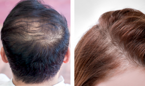 think ink micro esthetics, smp, scalp micropigmentation, scalp micropigmetnation for thinning hair, scalp micropigmentation for hair loss