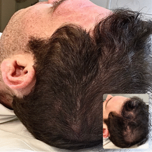 Male Full Density Added Throughout Head