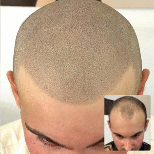 Hairline and Top of Head
