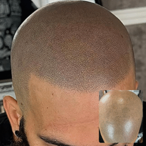 Scalp Micropigmentation Touchup