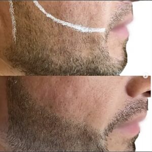 Beard Micropigmentation