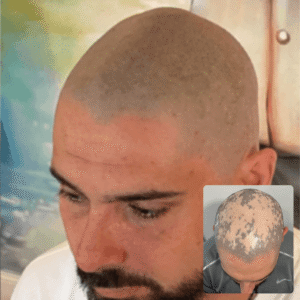 Severe Alopecia Treatment