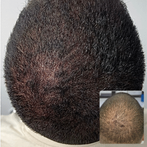 Density Added to Existing Hair at Crown or Top of Head