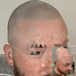Standard Full Treatment