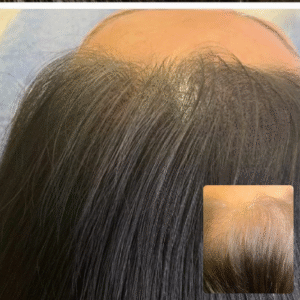 Woman Hairline and Top of Head