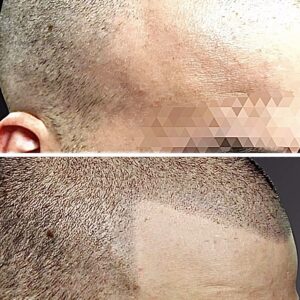 Hairline Only